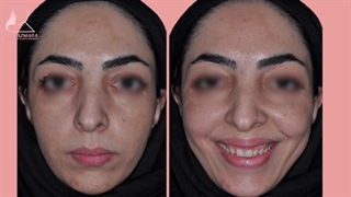 عمل بینی غضروفی استخوانی با انحراف تیغه بینی