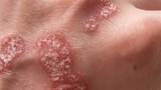 افزایش شیوع انواع آلرژی ها در دنیا