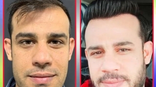 کاشت مو برای مراجعه کننده در کلینیک ترانسپلنت