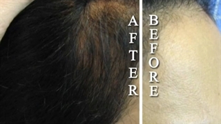 کاشت مــوی طبیعی