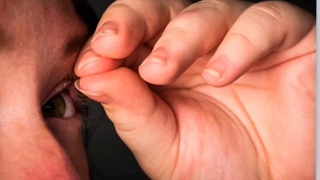 درمان اختلال مو کنی