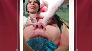 نمایش نتیجه عمل جراحی بینی توسط فوق تخصص در گرگان گنبد 09336093000