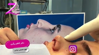 یه جراحی عالی روی بینی عقابی
