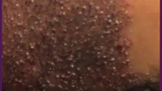 کاشت مو به روش سلول‌های بنیادی در ایران !! شایعه یا واقعیت؟