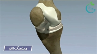 مینیسک زانو