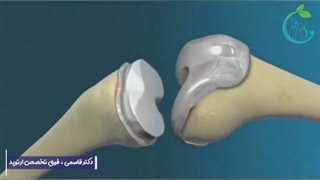 تعویض مفصل زانو