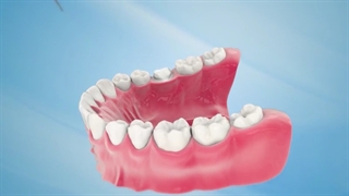 اینله و آنله سرامیکی جایگزین روکش دندان | سیمادنت