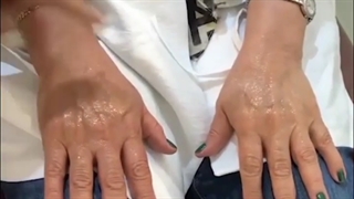 تزریق ژل به پشت دست