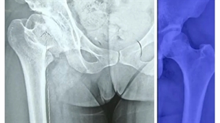 5ماه پس از تعویض مفصل لگن