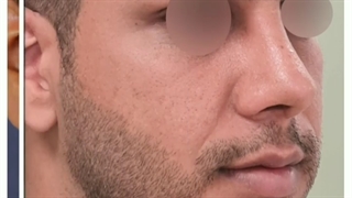 عمل بینی مردانه طبیعی