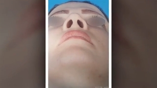 فیلم عمل جراحی بینی در اتاق عمل