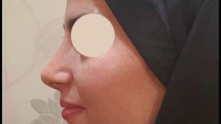 نتیجه جراحی زیبایی بینی بعد از 4 ماه