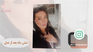 نتیجه فوق العاده بعد از جراحی بینی در مشهد