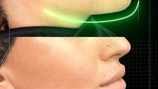 زاویه سازی فک با تزریق ژل