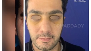 عکس قبل و بعد لیفت پیشانی