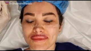 روند جراحی آگمنتیشن لب بالای تینای عزیز