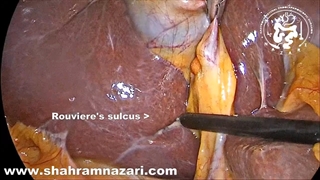 نمای ویژه در کله سیستکتومی لاپاروسکوپیک