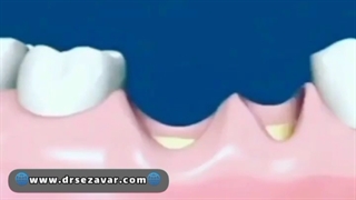 پودر استخوان برای ایمپلنت دندان