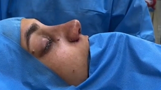 لایو جراحی بینی