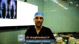 آرتروز و زانوی ضربدری