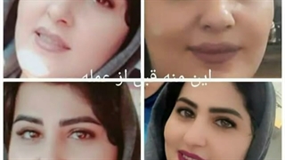 قبل و۶۲ روز بعد از عمل ورضایت زیباجوی عزیزمون