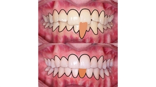 درمان تحلیل لثه با ارتودنسی | دکتر داودیان