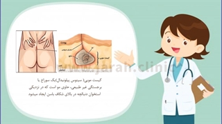 کیست مویی چیست؟-کلینیک نوین