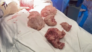 چه زمانی بعد از میومکتومی می‌توان سونوگرافی جهت کنترل رحم انجام داد