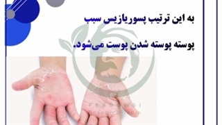 از پسوریازیس چی میدونی؟ صدفک دائو صدف psoriasis