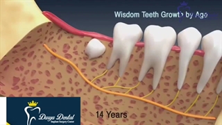 جراحی دندان عقل نهفته | کلینیک دریا 22