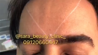 تزریق بوتاکس در ناحیه پیشانی و ابرو