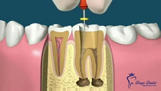 عصب کشی دندان  | کلینیک دریا 22