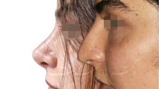 فیلم واقعی جراحی بینی