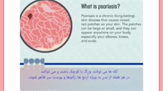 همه آنچه باید درباره پسوریازیس و درمان آن بدانید