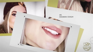 لمینت دندان توسط دکتر هومن عشقی