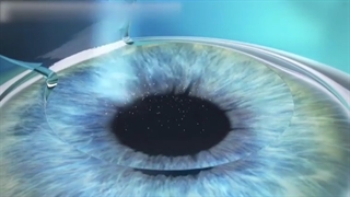 انیمیشن عمل فمتو لیزیک