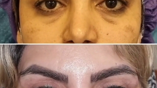 بلفاروپلاستی پلک های فوقانی