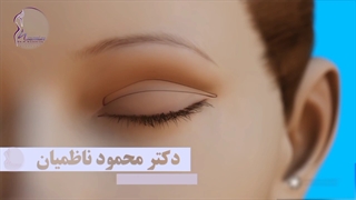 جراحی پلک فوقانی بدون بیهوشی