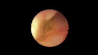 کلدوکوسکوپی / مجاری صفراوی داخل کبدی