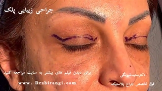 جراحی زیبایی پلک - جوانسازی پلک توسط دکتر شیرنگی