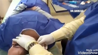 از بین بردن انواع آکنه اسکار با دستگاه پزشکی Endo-RF Subcision