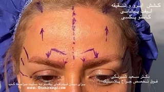 لیفت شقیقه و پیشانی یا کانتوپکسی توسط دکتر سعید شیرنگی
