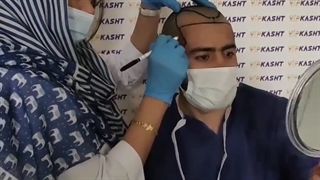 بهترین دستگاه کاشت مو هزینه کاشت مو 1401