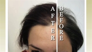 کاشت موی طبیعی برای خانمها