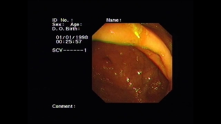 کلونوسکوپی / سکوم / دریچه ایلیوسکال