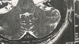 همی فاشیال اسپاسم
