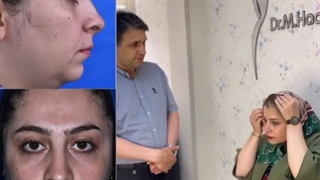 نتیجه جراحی بینی بعد از چهار ماه