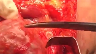 فیلم خارج سازی تومور از زانو