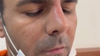 رینوپلاستی بعداز گذشت سه هفته