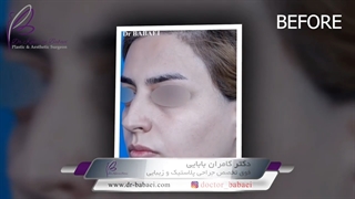 نمونه جراحی زیبایی بینی